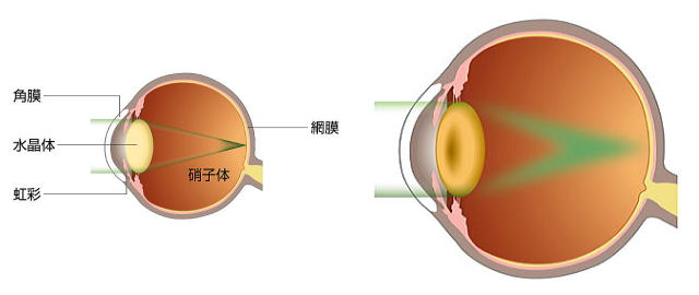 左：正常な人の眼に入ってくる光の道筋／右：白内障になった場合の患者さんは、光は網膜上にうまく集光できず、ピントが合わないような状態に。