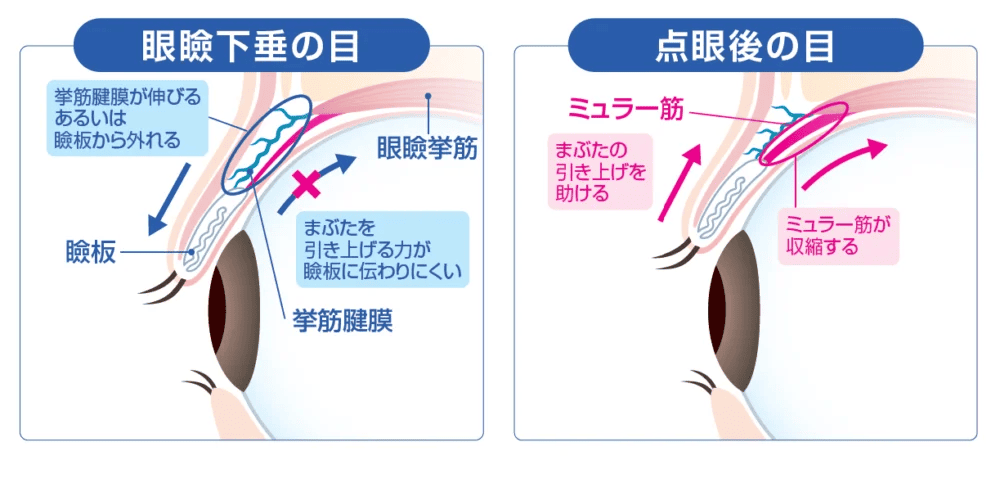アップニーク&reg;ミニ点眼液0.1%　作用機序