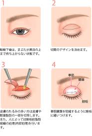 眼瞼下垂の手術その1】